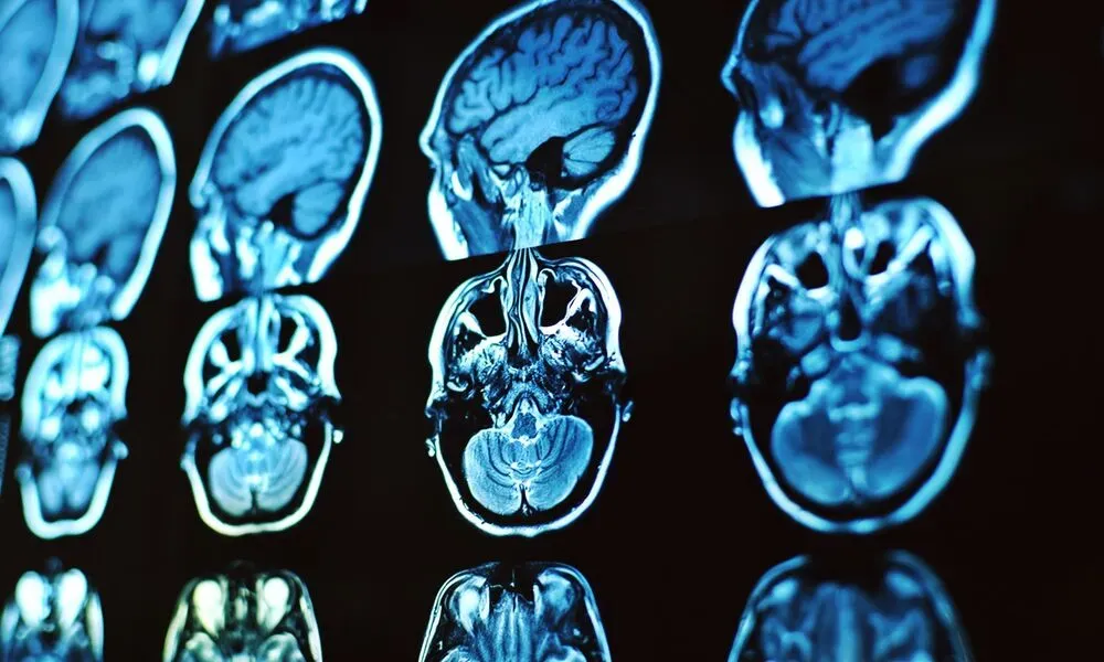 Diagnoza pielęgniarska i plan opieki nad chorym z guzem mózgu